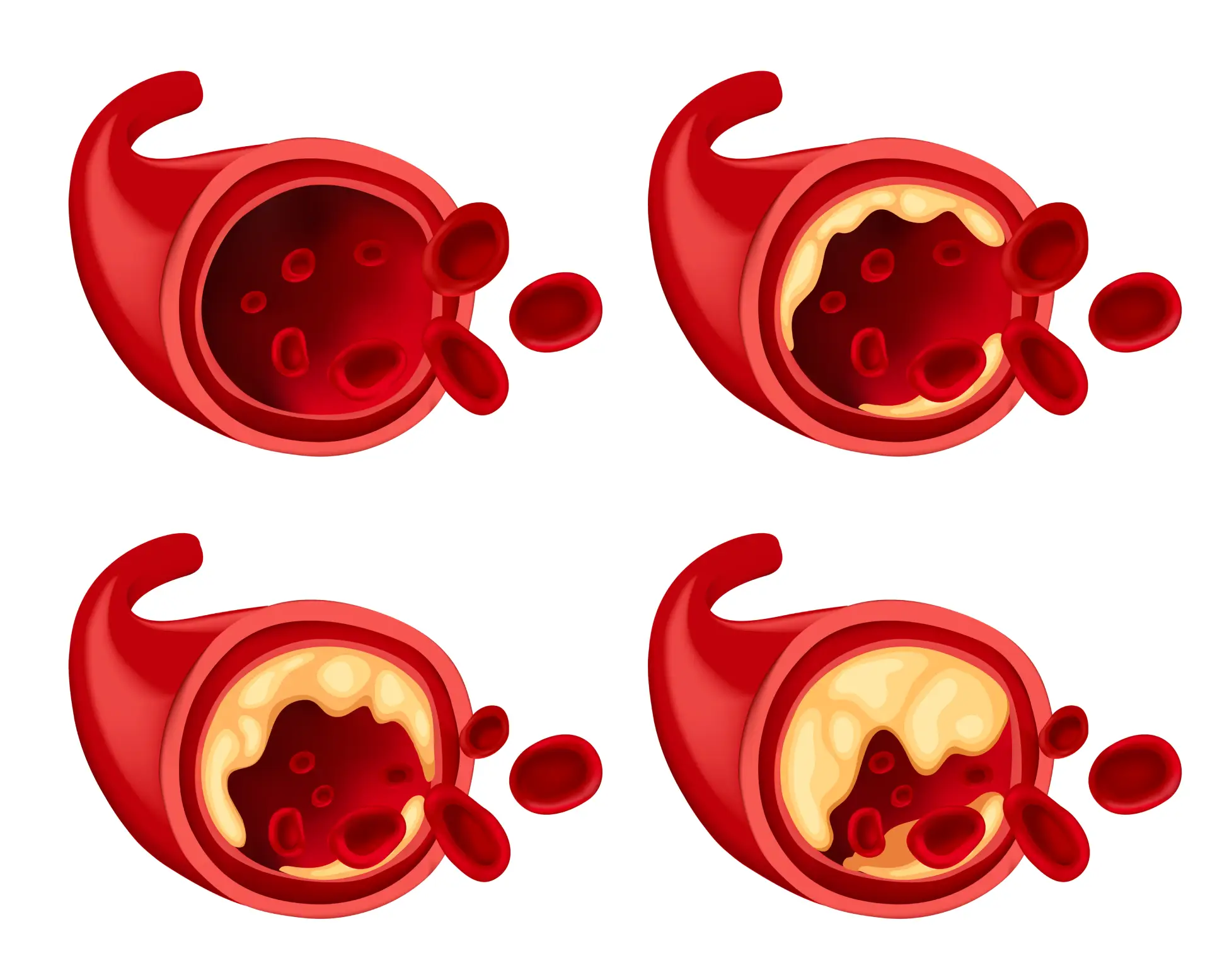 Imagem ilustrando a progressão do acúmulo de colesterol nas artérias.